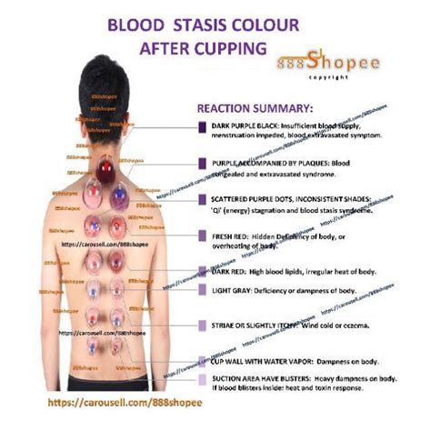 Pin By Mohsin On Health Hijama Cupping Points Cupping Therapy