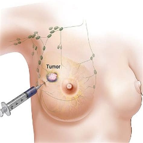 Meds weaken covid vaccine response. Breast Cancer Cure to come with Fewer Side Effects ...