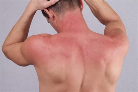 Already Sunburnt Heres What Dermatologists Would Do The Healthy