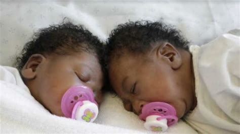 Separated After Birth Mas Joy At Op Success Of Her Conjoined Twins