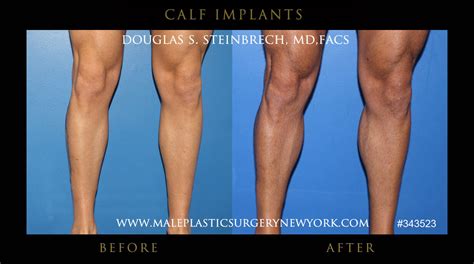 Calf Implants Gallery See Impressive Leg Transformations