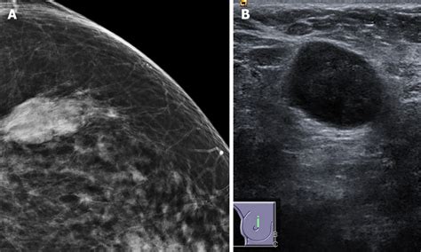 Role Of Mammogram And Ultrasound Imaging In Predicting Breast Cancer