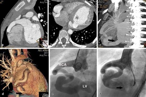 9 Coronary Artery Fistula Draining Into The Left Ventricle In A