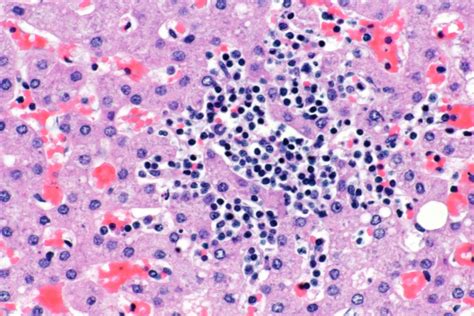 Pathology Cases — Focal Hepatocellular Necrosis Billoblog