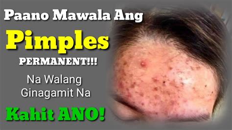 Pimple Marks Paano Mawala Ang Peklat Ng Tigyawat Sa Mukha