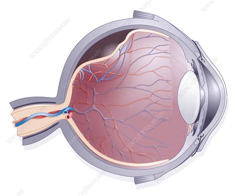 Retinal Detachment Illustration Stock Image C0063661 Science