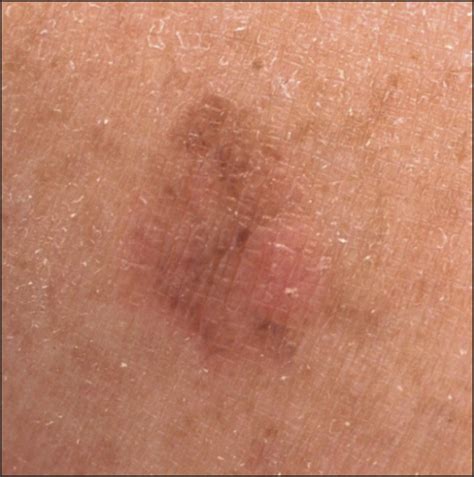 Multiple Lentigo Maligna Melanomas A Preliminary Report Dermatology Jama Dermatology Jama