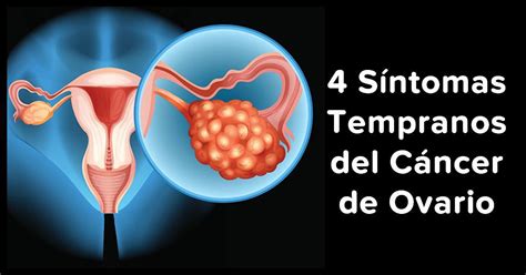S Ntomas Tempranos Del C Ncer De Ovario Que Debes Conocer