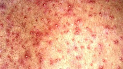 Alternatively, take a cold shower or bath to minimize the prickly sensation on your skin. Heat rash: Symptoms, treatment, appearance, and causes
