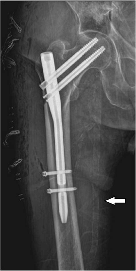 Cureus Does Presence Of Femoral Arterial Calcification Have An Effect
