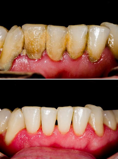 Teeth Falling Out Due To Gum Disease Teeth Poster