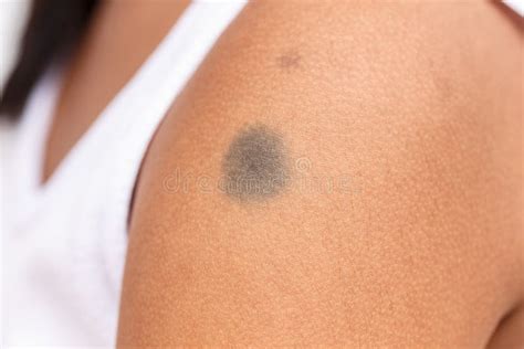 Black Birthmark On Skin Stock Image Image Of Birthmark 47495529