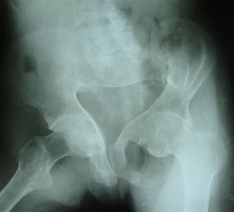 Osteomalacia Causes And Treatment Bone And Spine