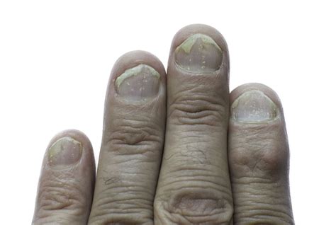 Nail Psoriasis Causes Symptoms Diagnosis Treatment