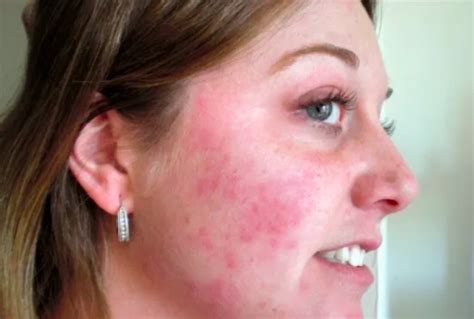 5 Effective Home Remedies For Acne Redness Skin Care Top News