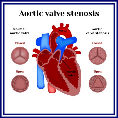 Aortic Valve Stenosis Vejthani Hospital Jci Accredited