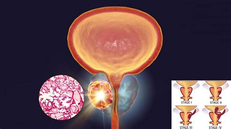 Anti Androgen Treatment Can Facilitate Prostate Cancer Cells To Adapt And Grow In The Bone Tumor