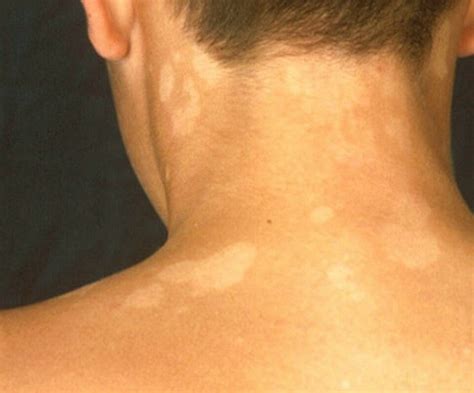 How To Remove Tinea Versicolor With Permanent Healthy Life
