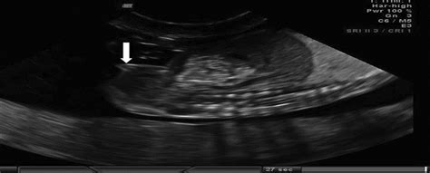 Sonographic Fetal Sex Determination Obstetrical And Gynecological Survey