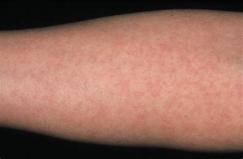 A Suspected Viral Rash In Pregnancy The Bmj