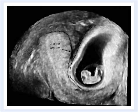 Figure 1 From The Pregnancy Outcome In Women With Incidental Diagnosis