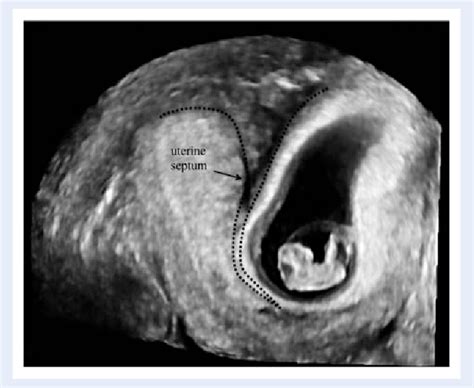 Figure From The Pregnancy Outcome In Women With Incidental Diagnosis