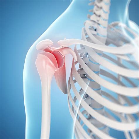 Relief From Shoulder Pain In Calgary Divergent Innovative Health Care