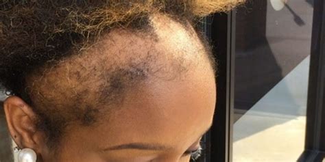 It can also affect younger women and is caused by a range of genetic and hormonal factors. This Woman's Honesty About Her Hair Loss Will Make You ...