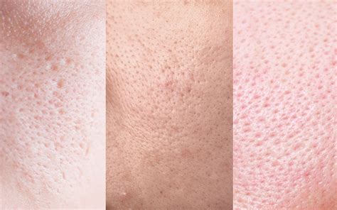 Large Pores Know Its Main Causes And Types Reequil