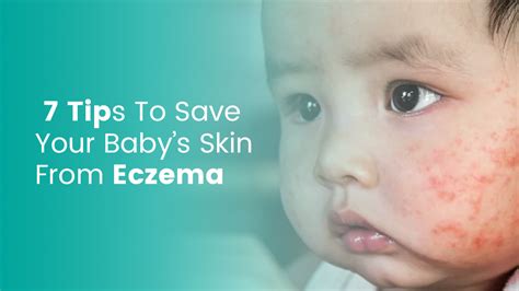 7 Tips To Save Your Babys Skin From Eczema Dr E Dermatology