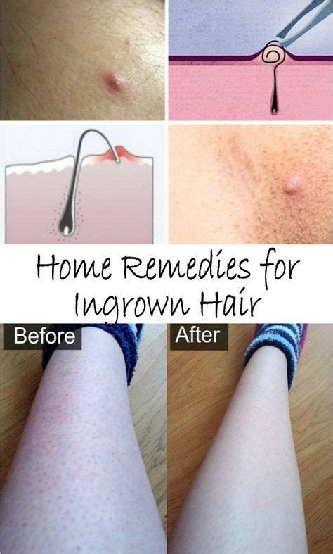 Ingrown Hair Is Generally Known As Razor Bumps That Have The Strength To Grow Back Into The