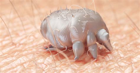 Scabies Outbreak In Nicu Reveals Challenges With Diagnosis