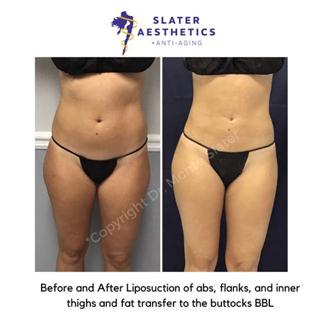 Brazilian Butt Lift Sculptra Butt Lift Results Dr Monte Slater