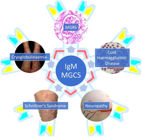 Frontiers Immunoglobulin M Monoclonal Gammopathies Of Clinical