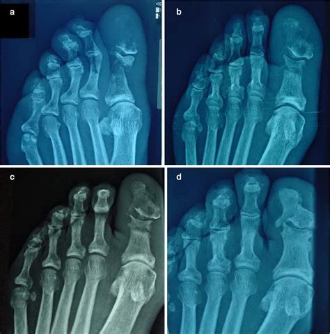 Successful Nonsurgical Therapy Of A Diabetic Foot Osteomyelitis In A Patient With Peripheral