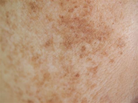 Brown Spots On Skin Causes Prevention And How To Remove Diyvines