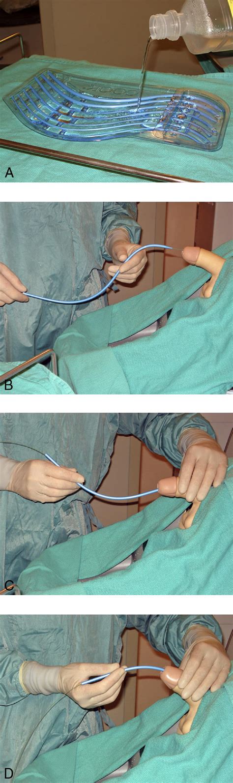 S Shaped Coaxial Dilators For Male Urethral Strictures Urology
