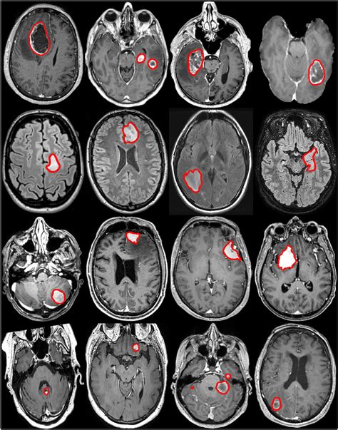 Frontiers Preoperative Brain Tumor Imaging Models And Software For Segmentation And