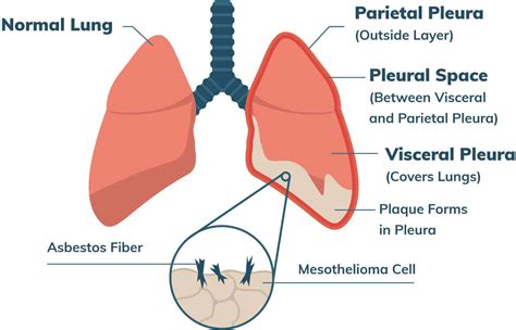 Malignant Mesothelioma Cancer Stages Prognosis Treatment