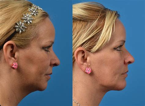 Patient 122406521 Laser Assisted Weekend Neck Lift Before And After