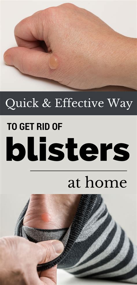 Quick And Effective Way To Get Rid Of Blisters At Home Health