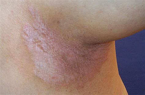 Inverse Psoriasis Causes Symptoms And When To See A Doctor