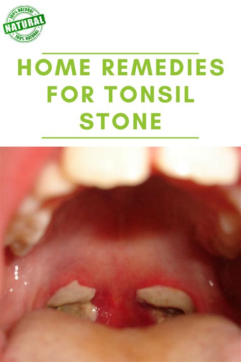 Remedies For Swollen Tonsils Throat Remedies Treatment For