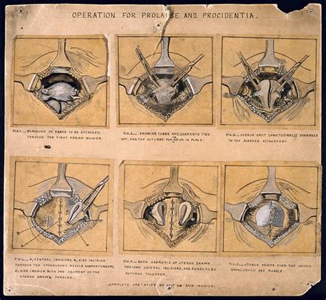 Six Diagrams Illustrating An Operation For A Prolapsed Uterus Free