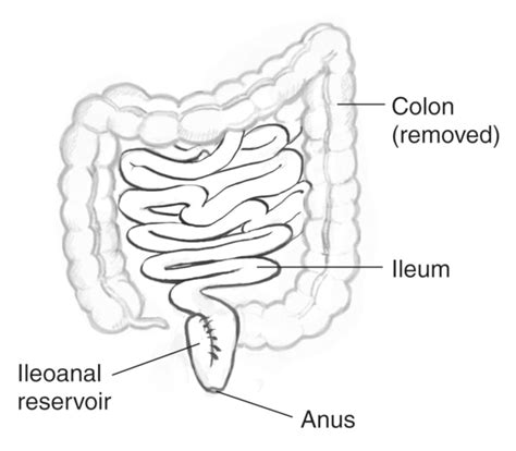 Removed Colon With Labels Pointing To The Colon Removed Ileum