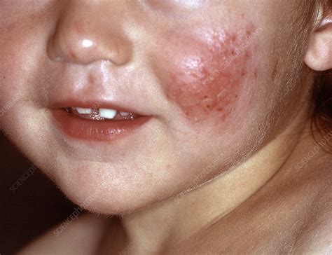 Atopic Dermatitis Stock Image C0509928 Science Photo Library