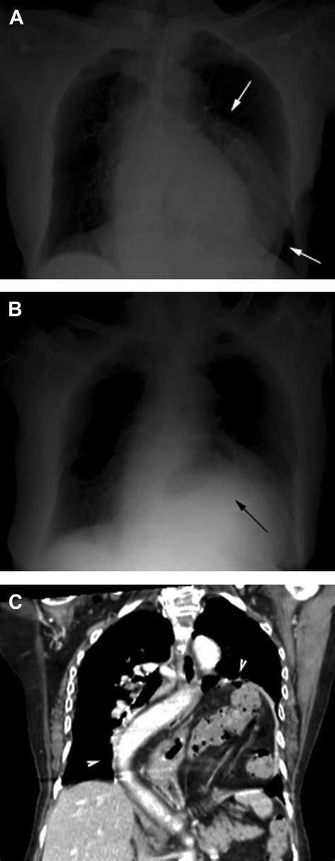 A Chest X Ray In Posteroanterior View Revealed A Huge Solitary Mass