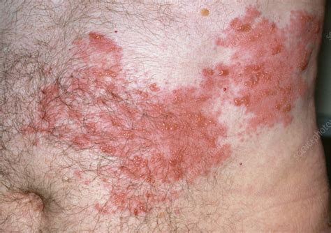 Shingles On A Mans Stomach Region Stock Image M2600125 Science