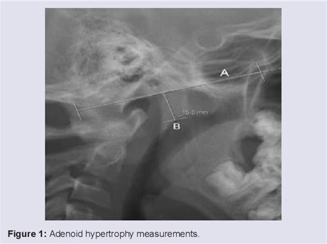 Figure 1 From An Eight Year Case Control Study Identifying Predictors