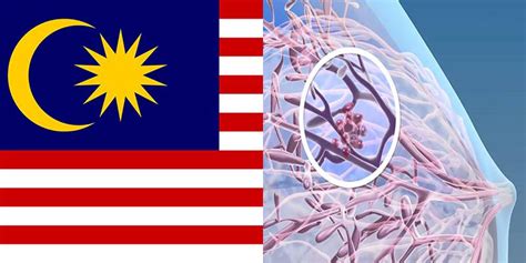 Malaysia cancer statistics data and figure peninsular malaysia 2006: Breast Cancer in Malaysia